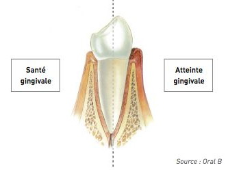 gingivite.001